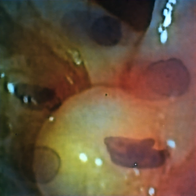 Blood-drop-obstructed Kvasir-SEG input captured through the hyperbolic metalens