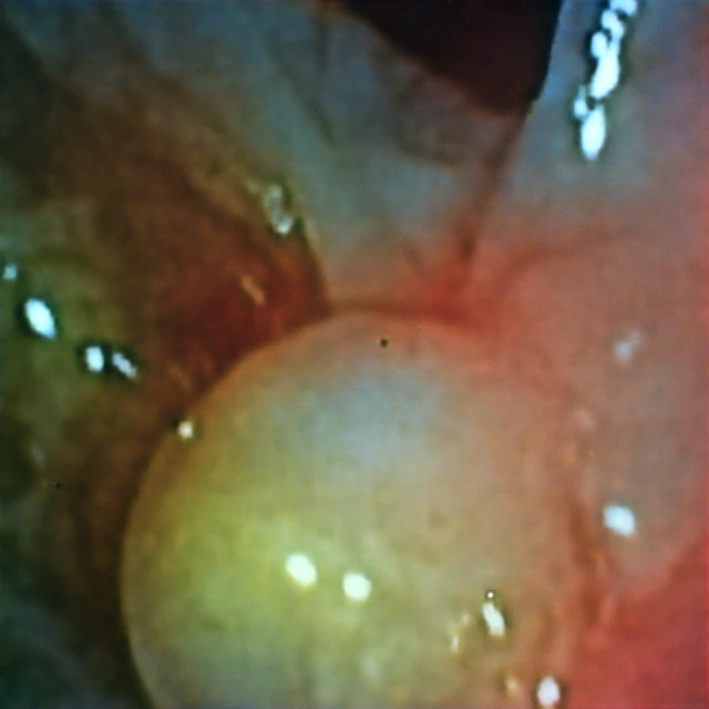 Unobstructed Kvasir-SEG input captured through the hyperbolic metalens